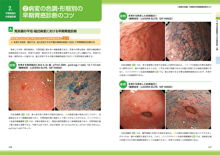 医学出版_書籍_消化管癌の画像強調内視鏡 診断と治療